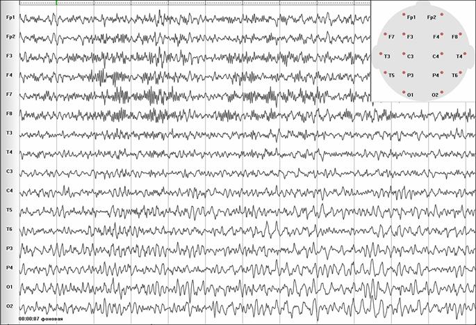 Рис.10. Передозировка барбитурата: замедление фоновой активности, дезорганизция Альфа-ритма, высокочастотная активность 15-25 Гц в передних отведениях (89kB)