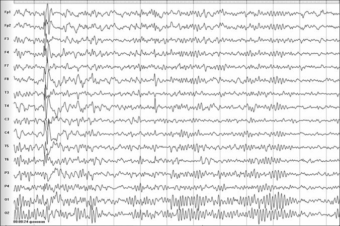 Рис.14. Тот же пациент. Естественная эволюция роландической эпилептиформной активности.  (77kB)