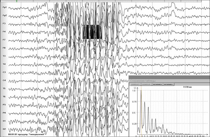 Рис.16. Типичный абсанс с не совсем ясной графикой. Спектр, характерный для типичного абсанса: пики мощности на частотах, кратным 3. (84kB)