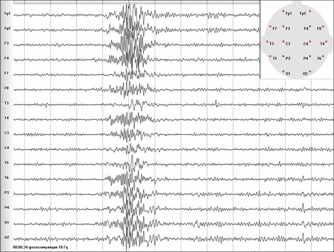 Рис.5. ГСВ при фотостимуляции - ФПР в ответ на ритмическую фотостимуляцию частотой 16 Гц. Единственный Grand mal на дискотеке с работающим стробоскопом (72kB)