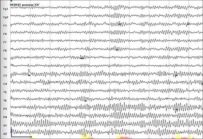 Усиление 50 мкВ /10 мм, скорость развертки30 мм/сек, ФВЧ 0.1 сек, ФНЧ 30 Гц. (ЭЭГ масштабирована, 50 мкв,1сек обозначены)