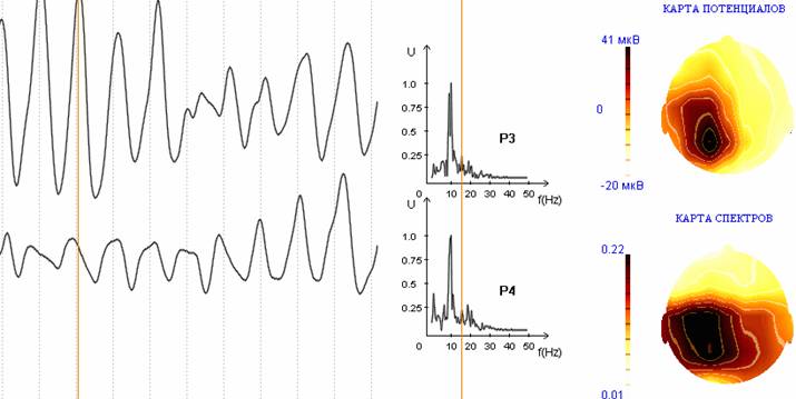 Увеличенная ЭЭГ спектры и карты участка с аномальной активностью в альфа диапазоне. 