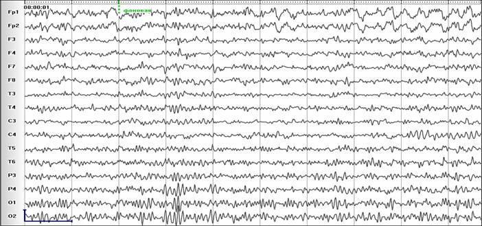 Результаты некоторых ЭЭГ исследований больной Ч. 