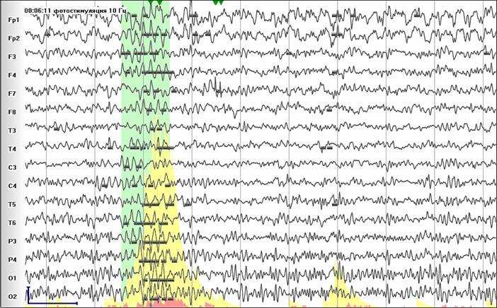 Вспышка в ответ на высокочастотную фотостимуляцию.