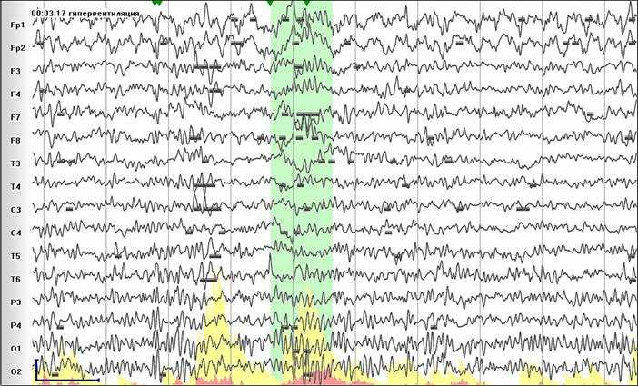 Изменение паттерна и вспышка в ответ на гипервентиляциюцию