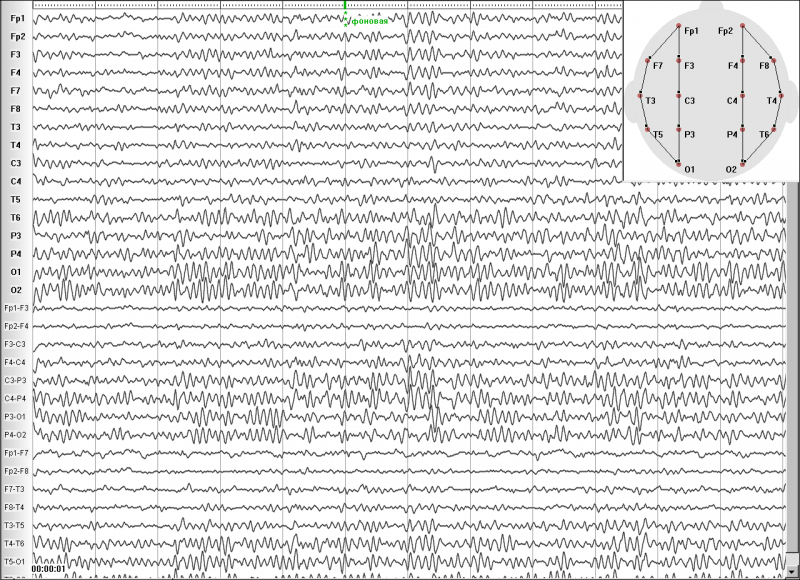 Синхронное преобразование к 32 канальной ЭЭГ. Просьба обратить внимание на качество записи и в монополярных и в биполярных отведениях
