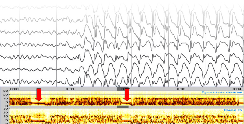 Типичные абсансы (указаны стрелками на графике мониторинга). Обнаружение таких короткоживущих и относительно редко встречающихся феноменов значительно облегчается при длительном мониторинге ЭЭГ. Система контроля спектральной плотности мощности позволяет врачу сосредоточить внимание не на относительно «спокойных» участках электроэнцефалограммы, а на феноменах, которые требуют тщательного анализа и оценки.