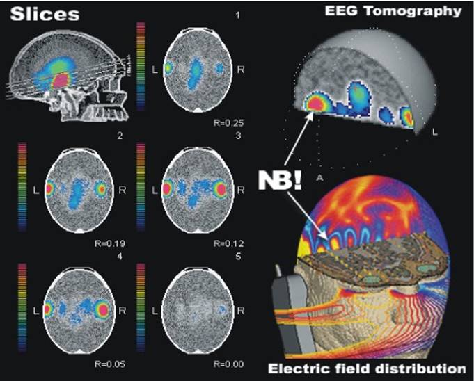 Fig.6. The comparison of probabilistic EEG tomography to the map of a cellular phone's field. Electroencephalograph ExpertTM made </p>
<p>by TREDEX Company Ltd. (Kharkov, Ukraine).  Proper observation.