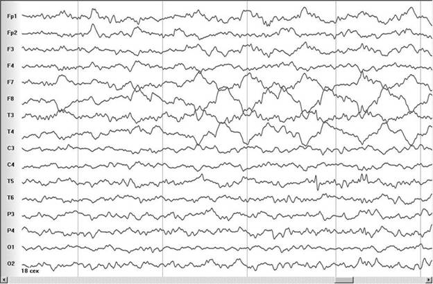 Fig.8. Slow-wave brain activity at F7, F8, T3, T4. 12 years old child EEG, 18 second after turning the cellular phone on. </p>
<p>Appearing of asymmetry at F3/F4 and T5/T6. Eyes are opened.  Proper observation.