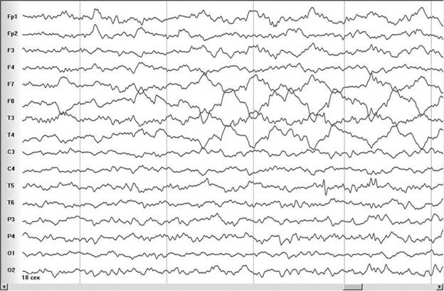 Медленноволновая активность в F7,F8,T3,T4 у ребенка 12 лет через 18 секунд после включения мобильного телефона. Появление асимметрии в F3 / F4 и T5 / T6. Глаза открыты. Собственное наблюдение.