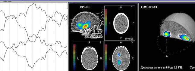 Fig.9. Typical triangular slow waves in child’s EEG and their localization (phone is near left ear unlike previous case). </p>
<p>Additive character of low frequency component is good visible. Proper observation.