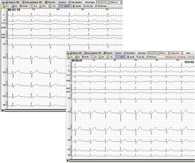 ЭКГ пациента А., м., 1962 г.р. Изображения масштабированы