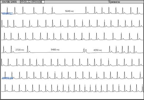 На представленном фрагменте ЭКГ первая продолжительная пауза 5640мс обусловлена асистолией за счет остановки синусового узла; далее регистрируется период синусовой брадиаритмии; затем преходящая СА блокада II степени; за следующим вслед за паузой 2720 мс синусовым комплексом вновь эпизод остановки синусового узла с интервалом RR 9480 мс; далее регистрируется выскальзывающий комплекс, возникающий по-видимому, одновременно в синусовом узле и АВ соединении; преходящая АВ блокада II степени 3:1. 
