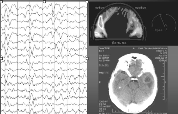 Рис.2 Сопоставление данных ЭЭГ томографии (по примитивному алгоритму) и КТ.  (46kB)